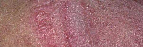 After using dry leather and ulcers in the head of the penis, after using bread soda