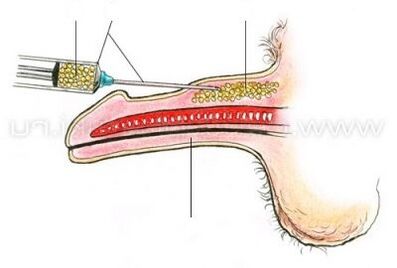 Injection penis enlargement